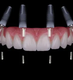 All-On-4
Implants