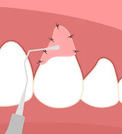 Pinhole Surgical Technique