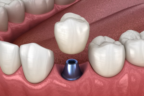 A Periodontist Can Treat Dental Implant Disease