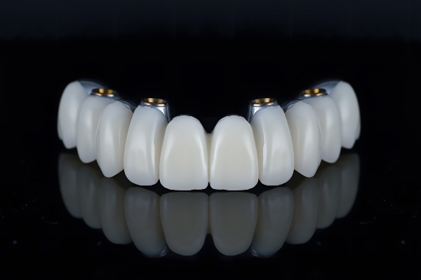 The Process Of All On Dental Implants By A Periodontist